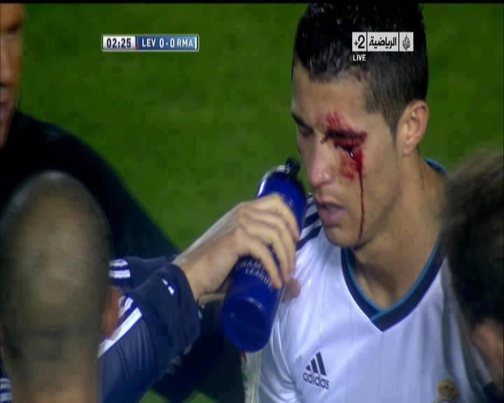 "Cristiano ronaldo injury" "Cristiano ronaldo injury vs levante"